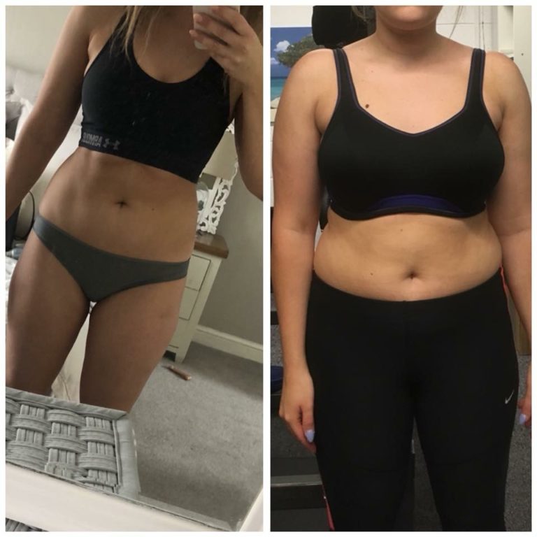 ms x before and after picture